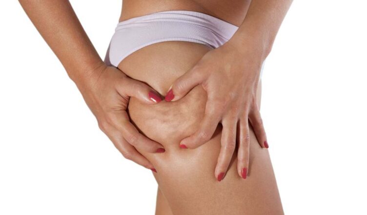 Czym jest cellulit? Jak walczyć z tym problemem?